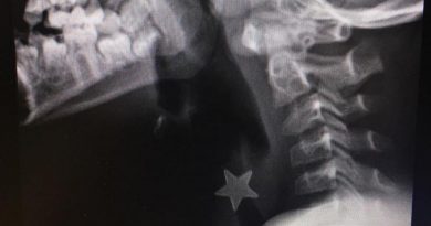 Una stella di metallo di 1,5 cm nella trachea. Bimbo di 8 anni rischia di soffocare, salvato all'ospedale Niguarda.