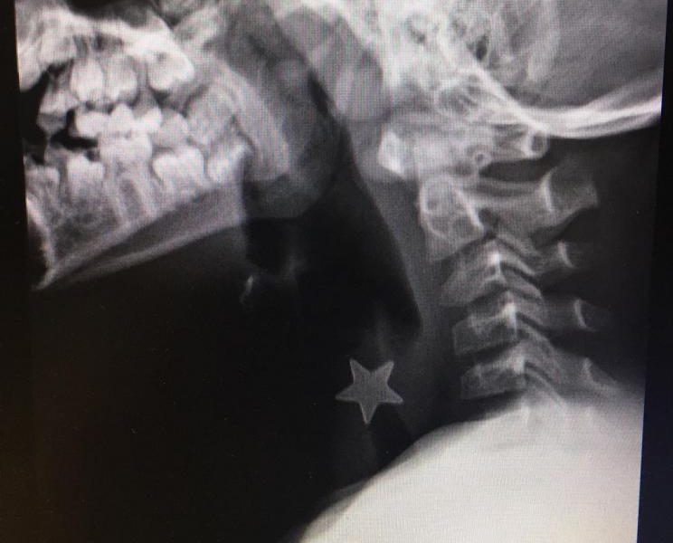 Una stella di metallo di 1,5 cm nella trachea. Bimbo di 8 anni rischia di soffocare, salvato all'ospedale Niguarda.