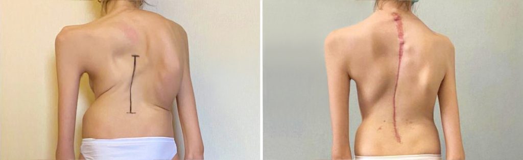 Scoliosi idiopatica: per la prima volta in Italia combinate due tecniche per la correzione di una grave scoliosi in una 15enne 2