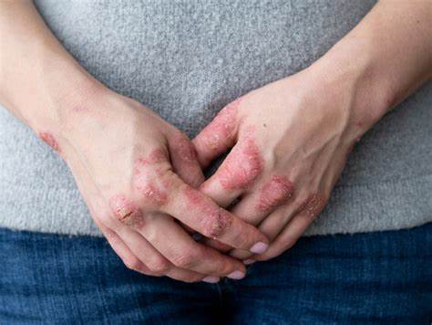 Caporali: artrite psoriasica spesso curata per la vita